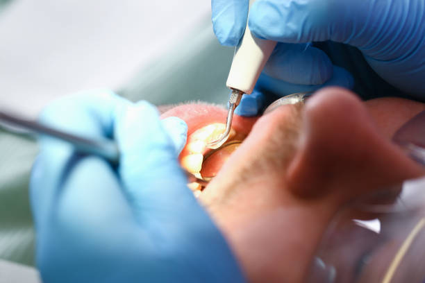 Best Emergency Dental Care for Broken or Chipped Teeth in Louisville, OH