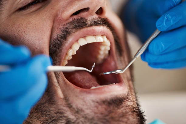 Best Emergency Tooth Extraction in Louisville, OH