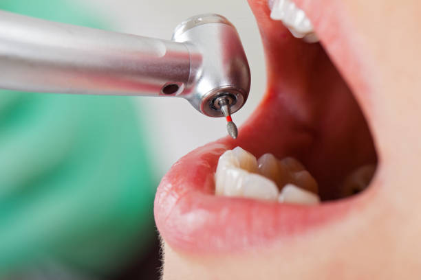 Best Emergency Dental Care for Broken or Chipped Teeth in Louisville, OH